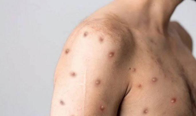 La viruela del mono se llamará a partir de ahora “MPOX”
