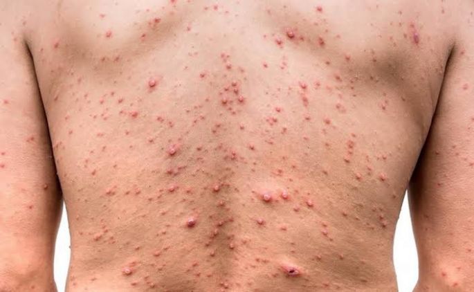 La OMS declara la MPOX (viruela del mono) una emergencia de salud pública internacional